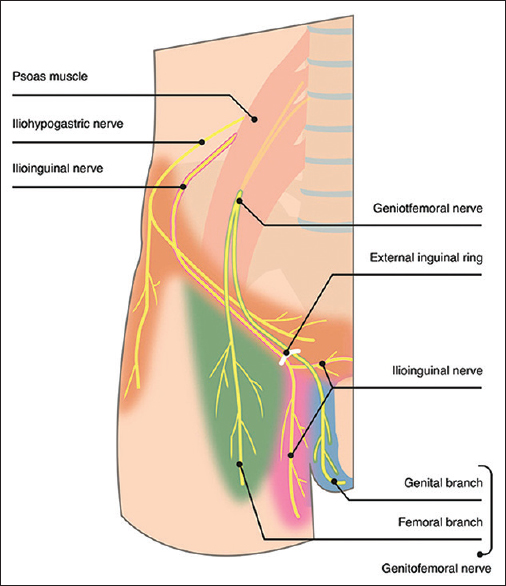 Pectineo-Femoral Pinch Syndrome