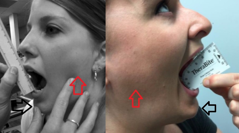 Fig. 10 – Red arrow=subluxing condyle, black arrow=mandibular retraction