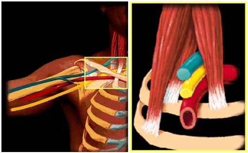 Thoracic Outlet Syndrome