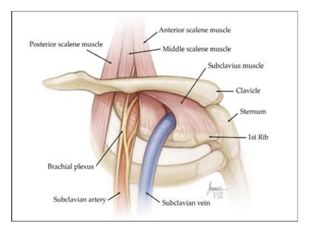 Thoracic Outlet Syndrome